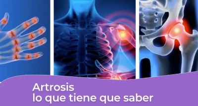 Artrosis-lo-que-tiene-que-saber